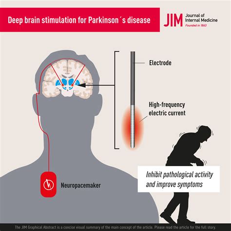 direct brain stimulation for parkinson's